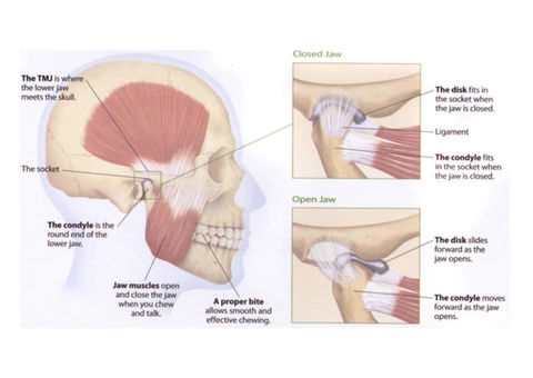 Reduce Symptoms of TMJ Treatment in Melbourne