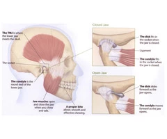 Reduce Symptoms of TMJ Treatment in Melbourne