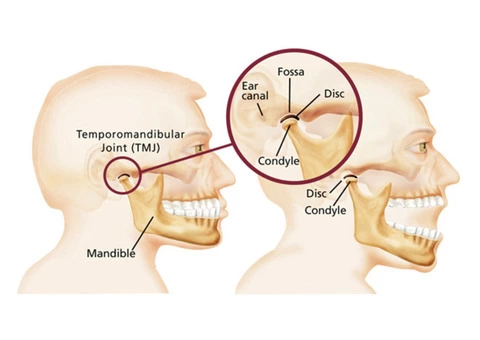 Reduce Symptoms of TMJ Treatment in Melbourne - 2/2