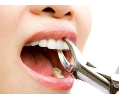 Cheap Wisdom Teeth Removal in Caroline Springs - Parkwood Green Dental