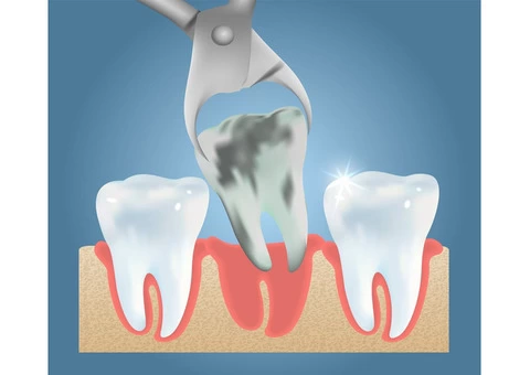 The Best Wisdom Tooth Extraction Cost in Melbourne - 2/2