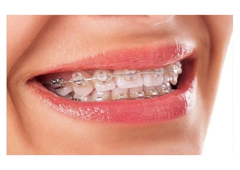 Best Invisalign Clear Braces Melbourne - 3/3