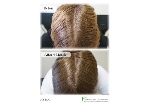 Recover from your loss with our natural hair loss treatment Gold Coast