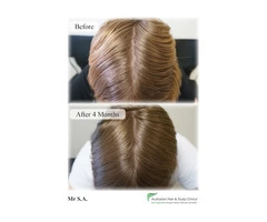 Recover from your loss with our natural hair loss treatment Gold Coast