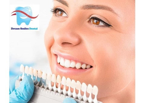 Dental Veneers Treatment in Carlingford, Australia