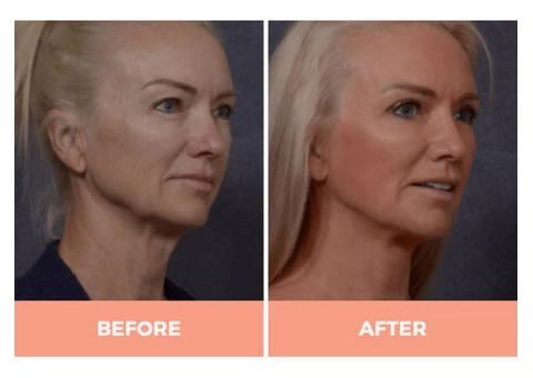 Effective Facelift Surgery in Sydney By Renowned Facial Surgeon Dr Hodgkinson! - 1/5