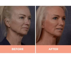 Effective Facelift Surgery in Sydney By Renowned Facial Surgeon Dr Hodgkinson!