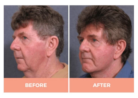 Effective Facelift Surgery in Sydney By Renowned Facial Surgeon Dr Hodgkinson! - 2/5