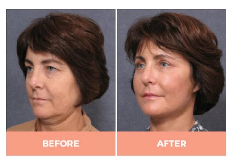 Effective Facelift Surgery in Sydney By Renowned Facial Surgeon Dr Hodgkinson! - 3/5