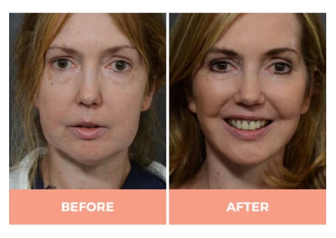 Effective Facelift Surgery in Sydney By Renowned Facial Surgeon Dr Hodgkinson! - 4/5