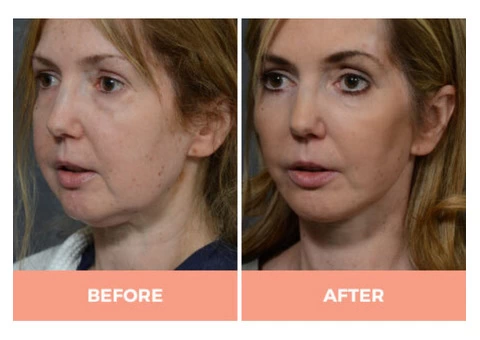 Effective Facelift Surgery in Sydney By Renowned Facial Surgeon Dr Hodgkinson! - 5/5