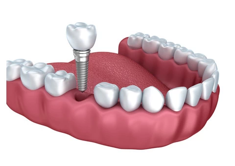 Springvale Dental Implant  Services