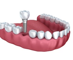 Springvale Dental Implant  Services