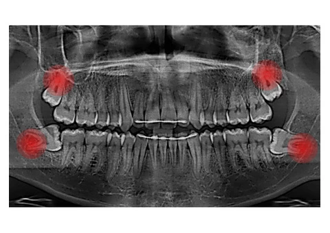 Dental Implant and Cosmetic Dentistry in Bundoora - Plenty Smiles