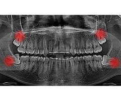 Dental Implant and Cosmetic Dentistry in Bundoora - Plenty Smiles