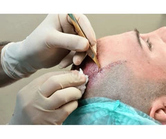 Hair Transplant Sydney Australia