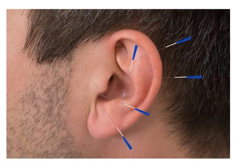 Acupuncture In Brisbane - 2/4