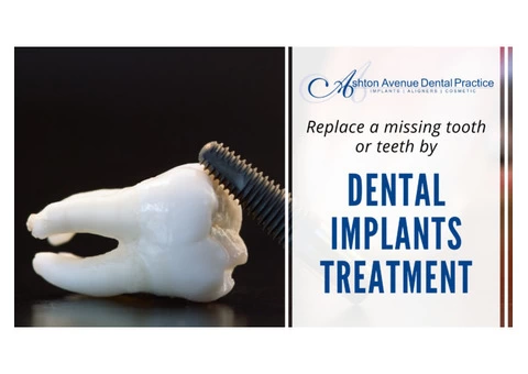 Are You Looking for Dental Implants in Perth?