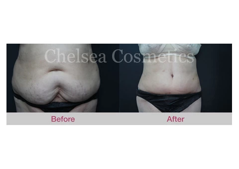Get the Flat, Contoured Stomach You’ve Always Wanted With This Tummy Tuck Surgery in Melbourne! - 1/4