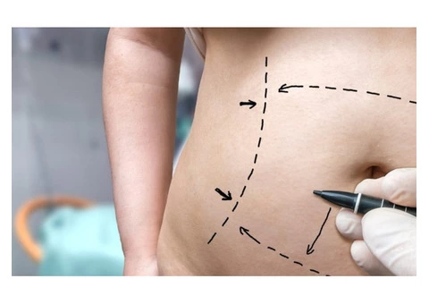 Get the Flat, Contoured Stomach You’ve Always Wanted With This Tummy Tuck Surgery in Melbourne! - 2/4