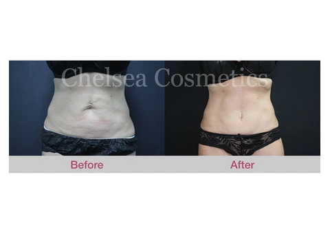 Get the Flat, Contoured Stomach You’ve Always Wanted With This Tummy Tuck Surgery in Melbourne! - 3/4