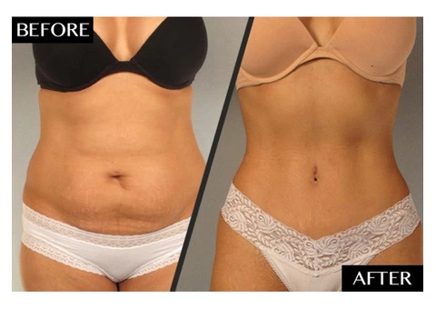 Get the Flat, Contoured Stomach You’ve Always Wanted With This Tummy Tuck Surgery in Melbourne! - 4/4