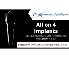 Who can Benefit from All on 4 Dental Implants?
