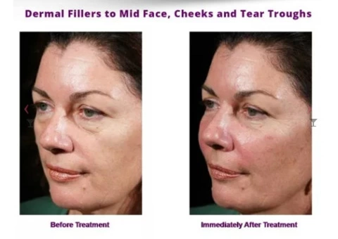Dermal Fillers in Camberwell – Timeless Anti Ageing Clinic