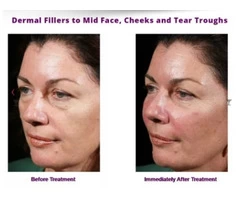 Dermal Fillers in Camberwell – Timeless Anti Ageing Clinic