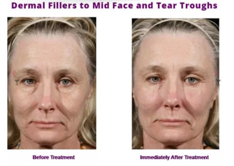 Dermal Fillers in Camberwell – Timeless Anti Ageing Clinic - 2/2