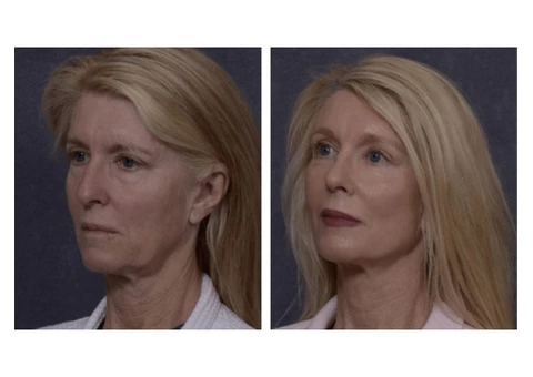 Professional Facelift Surgery in Sydney Performed by Dr. Hodgkinson! - 1/4