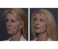 Professional Facelift Surgery in Sydney Performed by Dr. Hodgkinson!