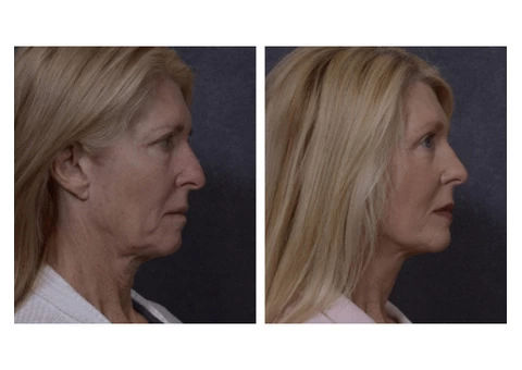 Professional Facelift Surgery in Sydney Performed by Dr. Hodgkinson! - 2/4