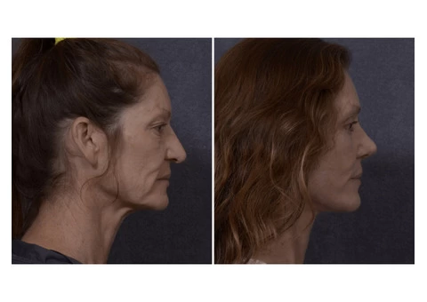 Professional Facelift Surgery in Sydney Performed by Dr. Hodgkinson! - 3/4
