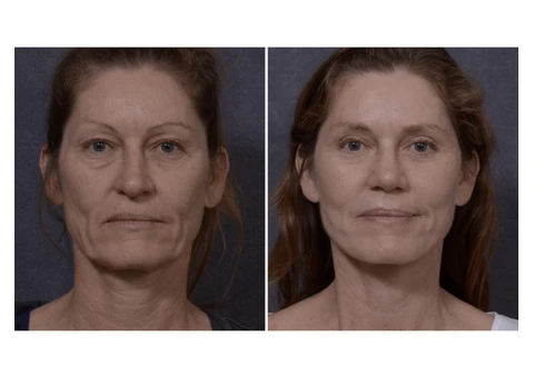 Professional Facelift Surgery in Sydney Performed by Dr. Hodgkinson! - 4/4