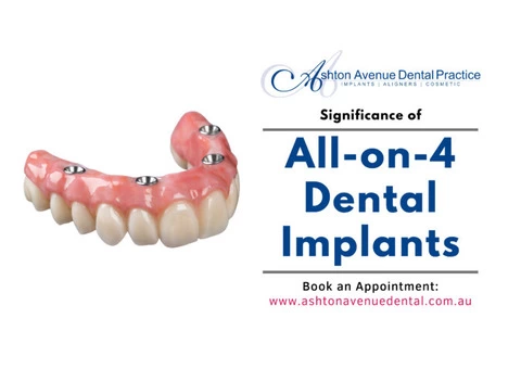 What is the Significance of All-on-4 Dental Implants?
