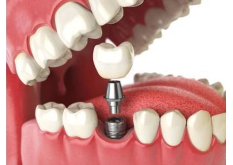 Affordable Tooth Replacement in Sydenham - Parkwood Green Dental