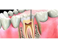 Root Canal Treatment - Springvale Dental Clinic