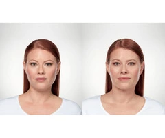 Keyword kybella vs coolsculpting