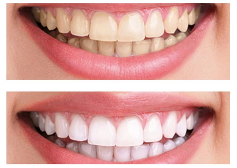 Teeth Whitening - (03 95788500) - BEDC