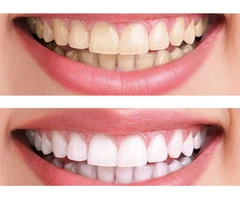 Teeth Whitening - (03 95788500) - BEDC