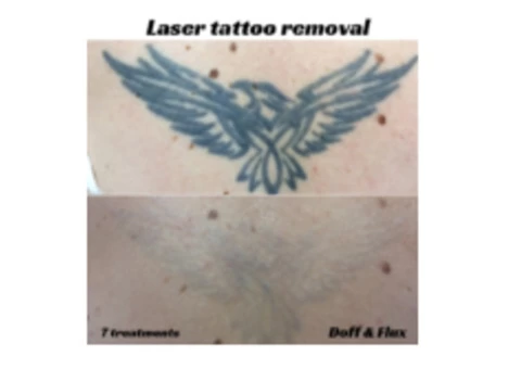 Laster Tatoo Removal Melbourne - Doff&Flux Tattoo Removal Melbourne - 1/7