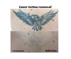 Laster Tatoo Removal Melbourne - Doff&Flux Tattoo Removal Melbourne