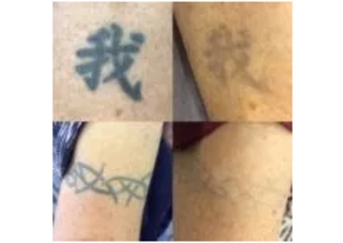 Laster Tatoo Removal Melbourne - Doff&Flux Tattoo Removal Melbourne - 3/7