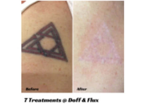 Laster Tatoo Removal Melbourne - Doff&Flux Tattoo Removal Melbourne - 4/7