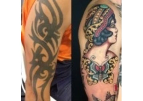 Laster Tatoo Removal Melbourne - Doff&Flux Tattoo Removal Melbourne - 5/7