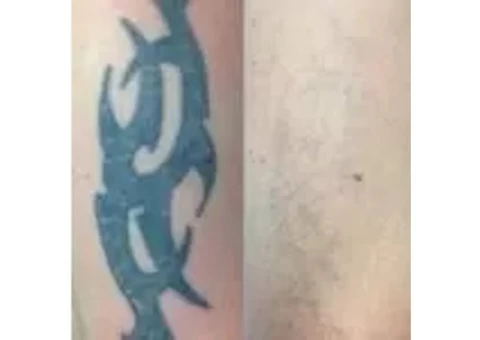 Laster Tatoo Removal Melbourne - Doff&Flux Tattoo Removal Melbourne - 6/7