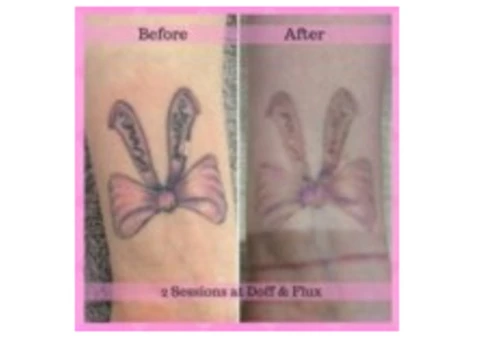 Laster Tatoo Removal Melbourne - Doff&Flux Tattoo Removal Melbourne - 7/7