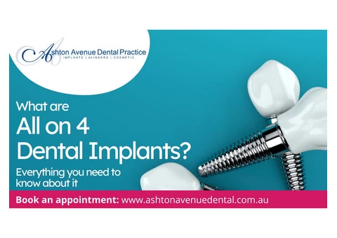What are All on 4 Dental Implants? Here is Everything you Need to Know About