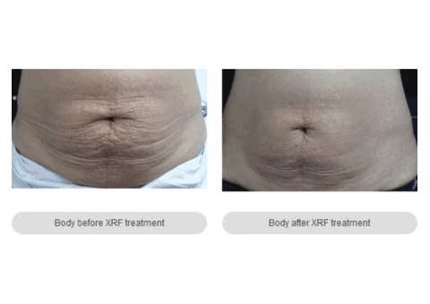 Body Contouring Melbourne - anti-aging Cosmetic & Laser